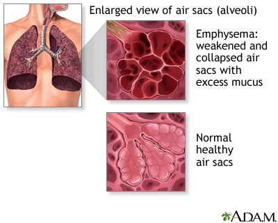 smoking lungs and healthy lungs. lungs become swollen